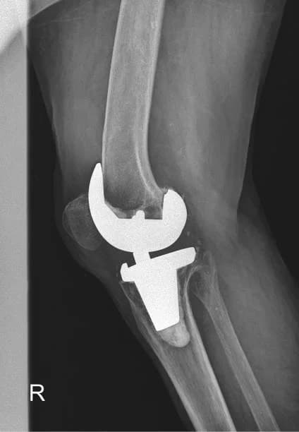 Hip rehabilitation session for South Delhi patient