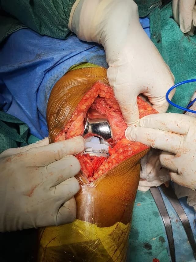 Senior citizen walking confidently after knee replacement