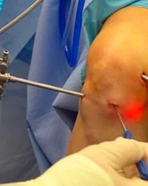 Arthroscopy instruments prepared for surgery