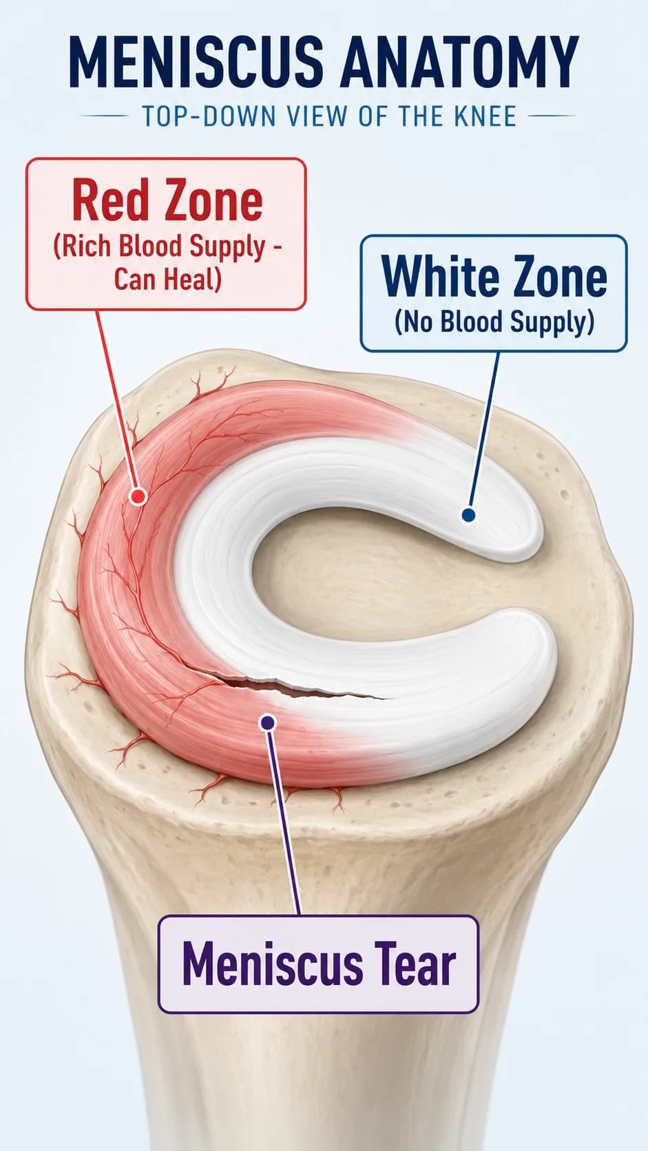 Anatomical diagram of a knee joint showing a meniscus tear in the red zone versus white zone