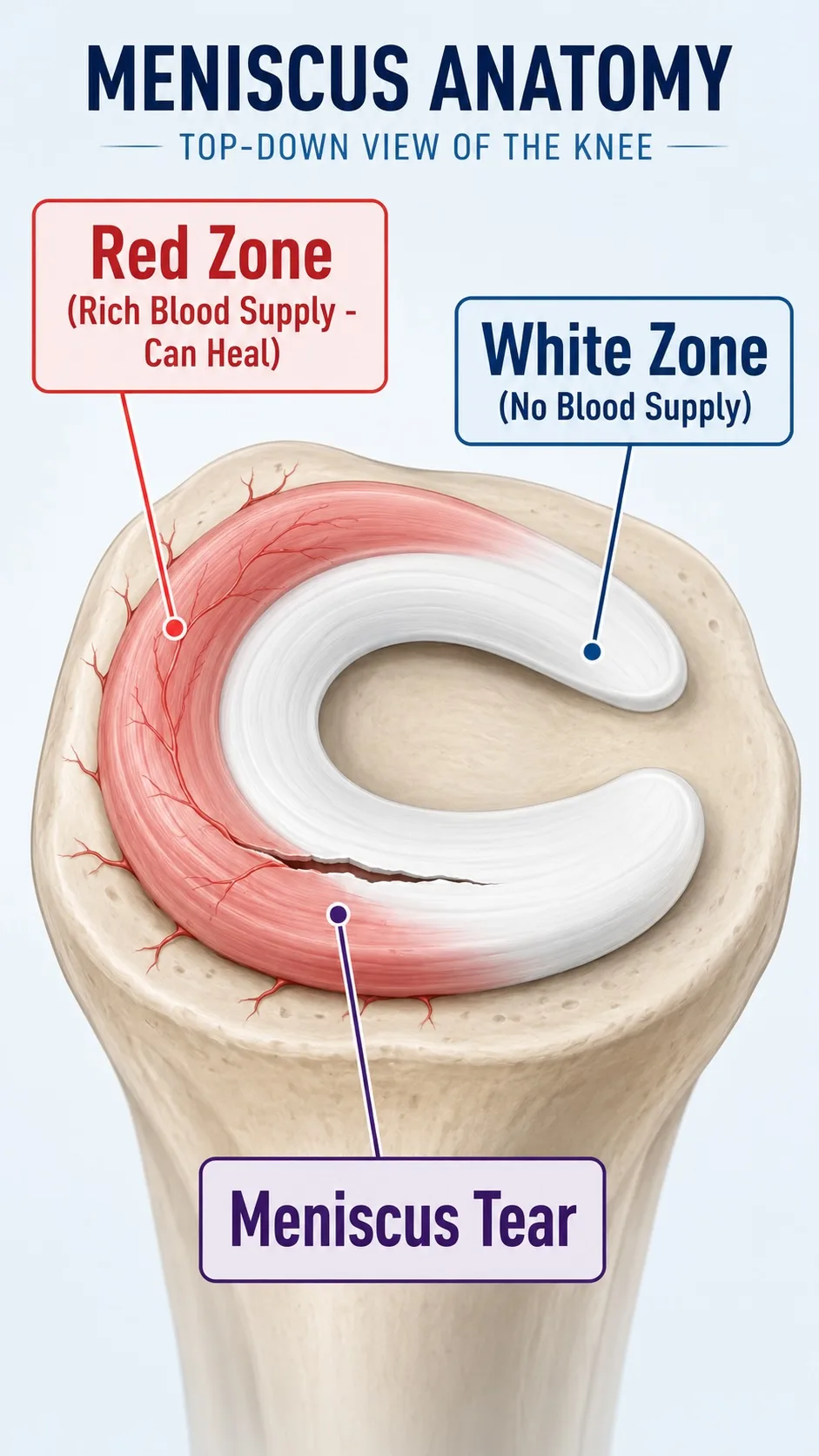 Can a Meniscus Tear Heal Without Surgery? | Dr. Himanshu Gaur